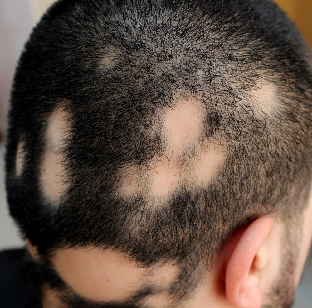 ispadanje kose alopecija